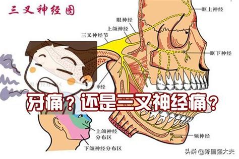 左邊臉痛|三叉神經痛 / 面部痛症 / 牙骹痛